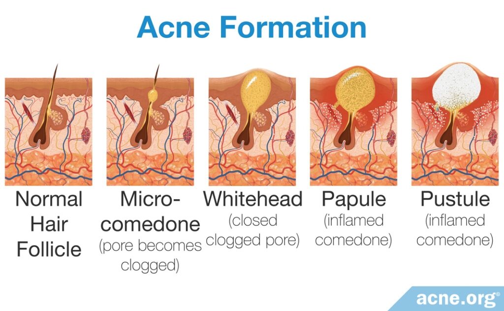 formação da acne