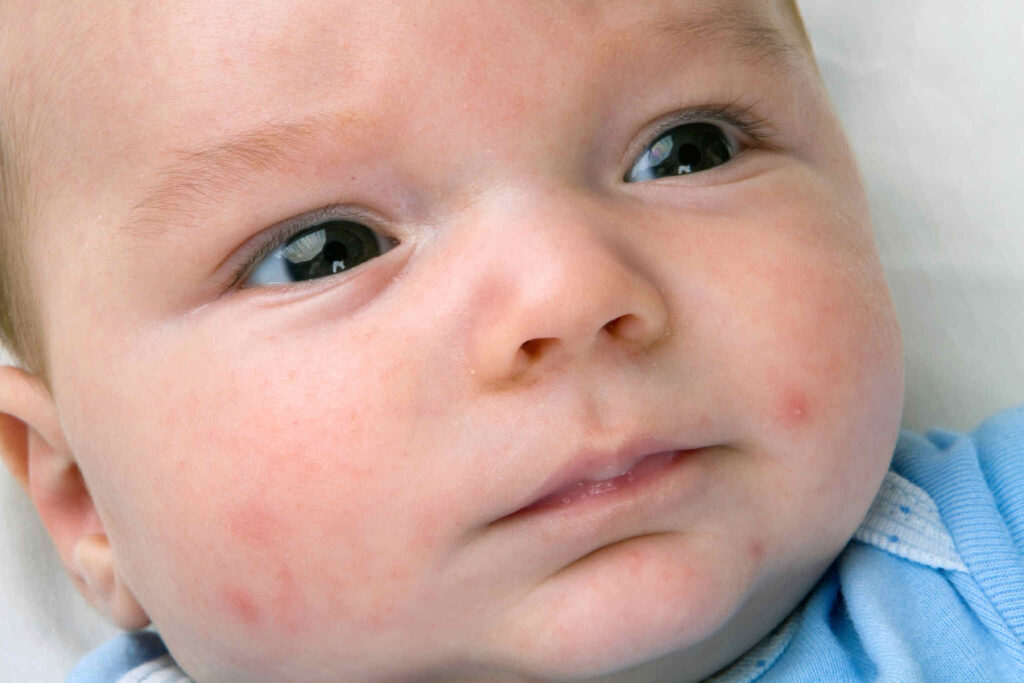 acne no bebê