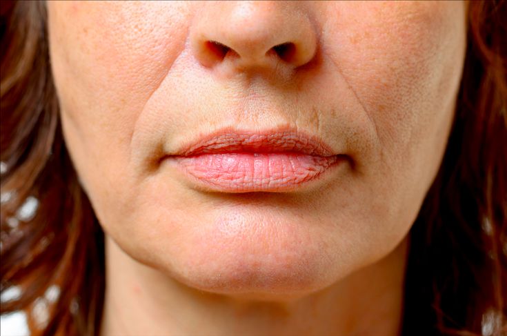 Mulher com rugas tipo bigode chinês