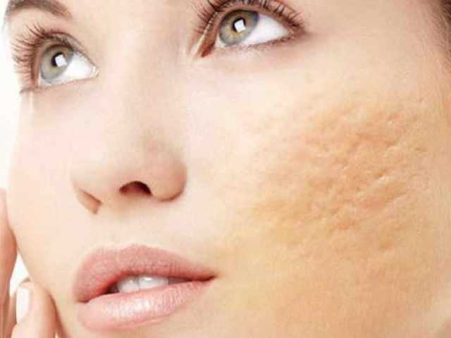 mulher com cicatrizes de acne