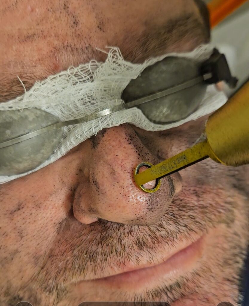 peeling a laser