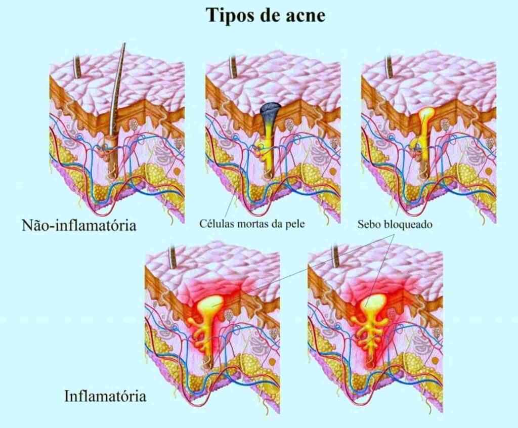 tipos de acne
