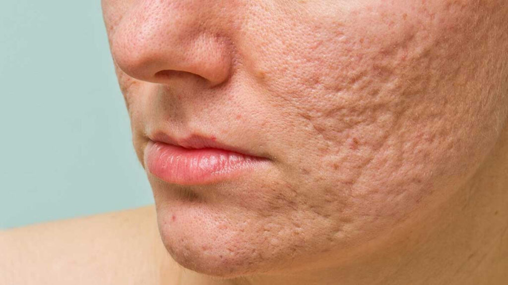 cicatrizes de acne