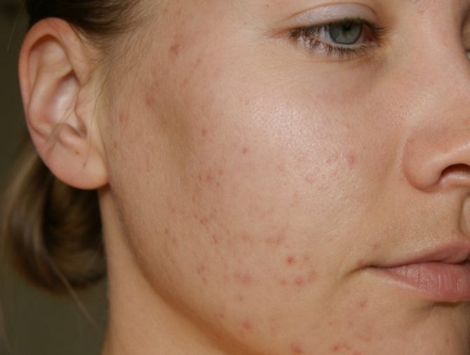 Acne e cicatrizes de acne que podem ser tratadas com peelings.