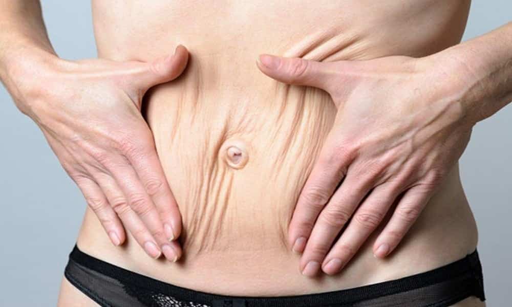 Flacidez na barriga
