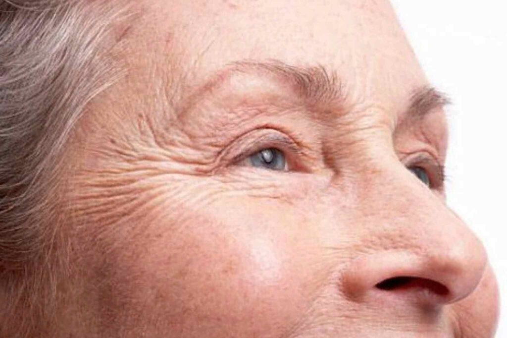 Foto de uma mulher idosa com a pele muito envelhecida.