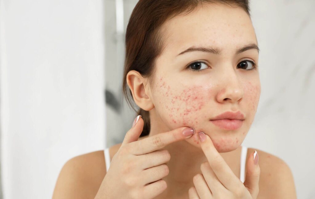 adolescente com acne