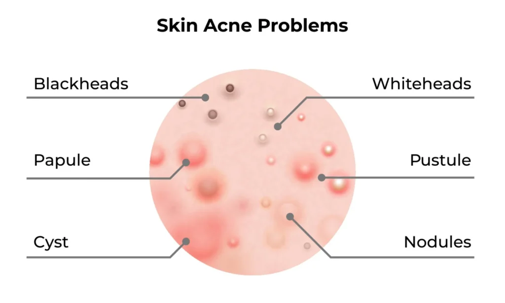 tipos de acne parte 2