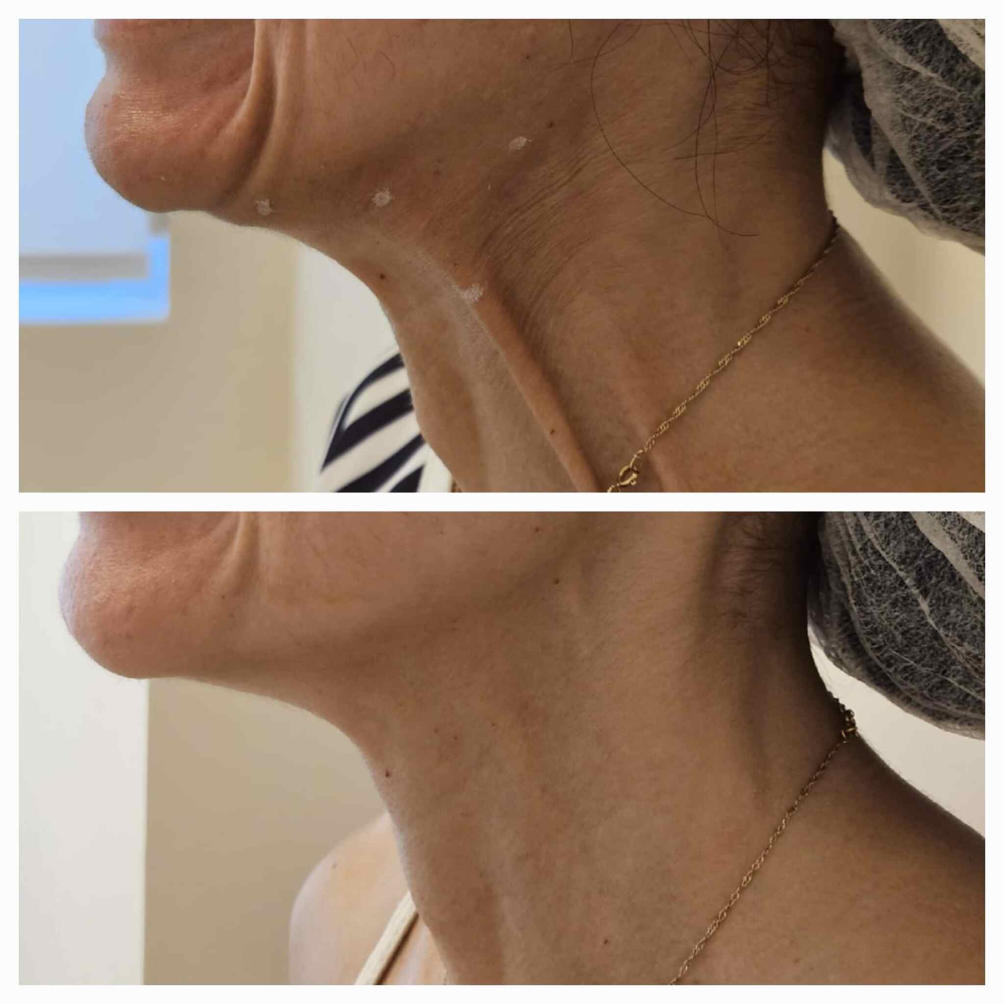 Indicação de aplicação de toxina botulínica extra facial-no caso antes e após toxina botulínica no pescoço