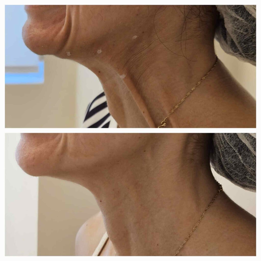 Indicação de aplicação de toxina botulínica extra facial-no caso antes e após toxina botulínica no pescoço