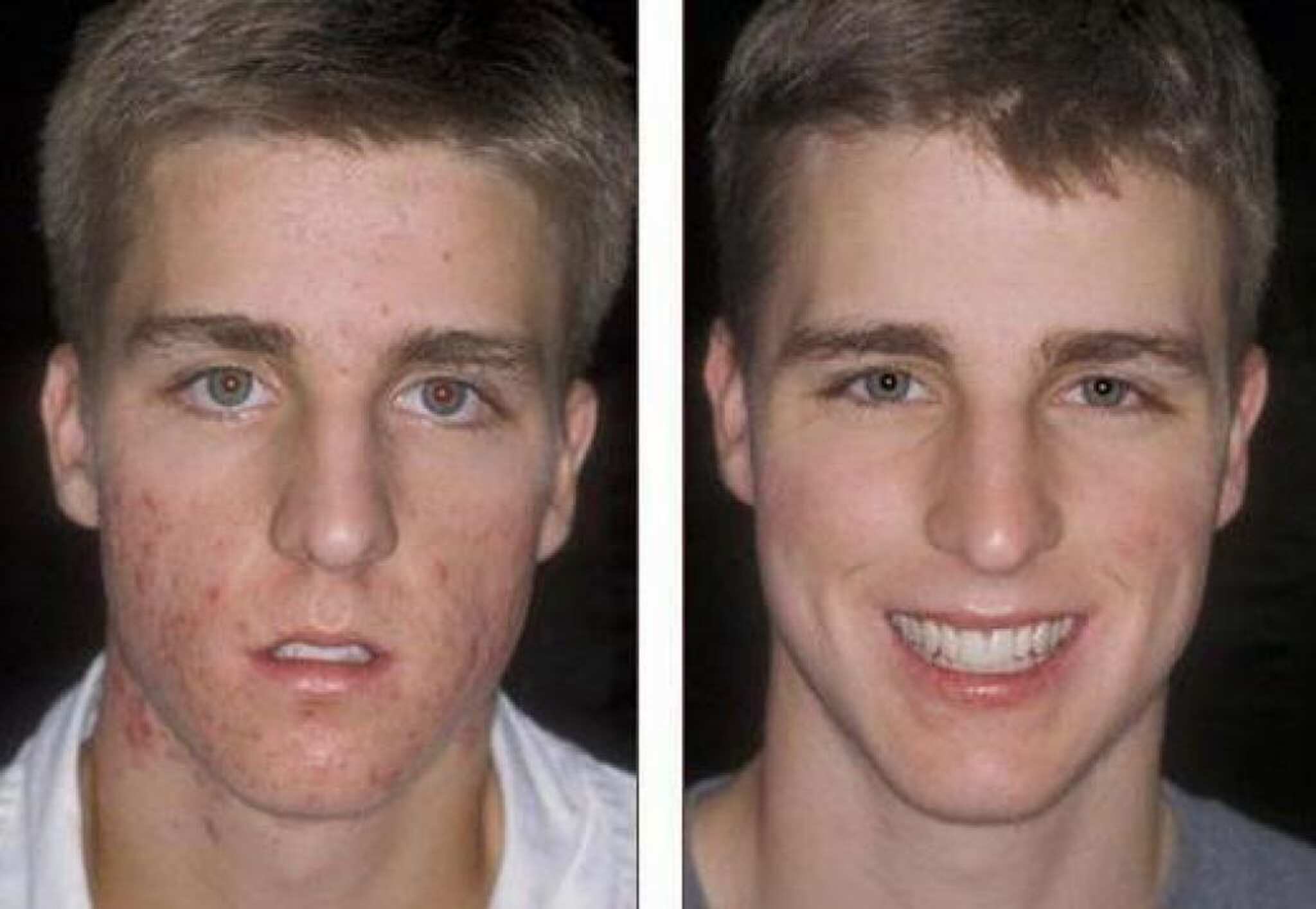 acne antes e depois