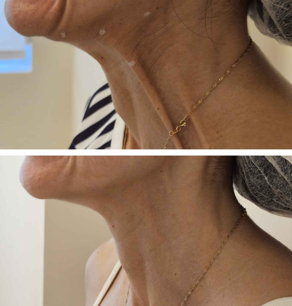 foto de toxina botulínica no pescoço