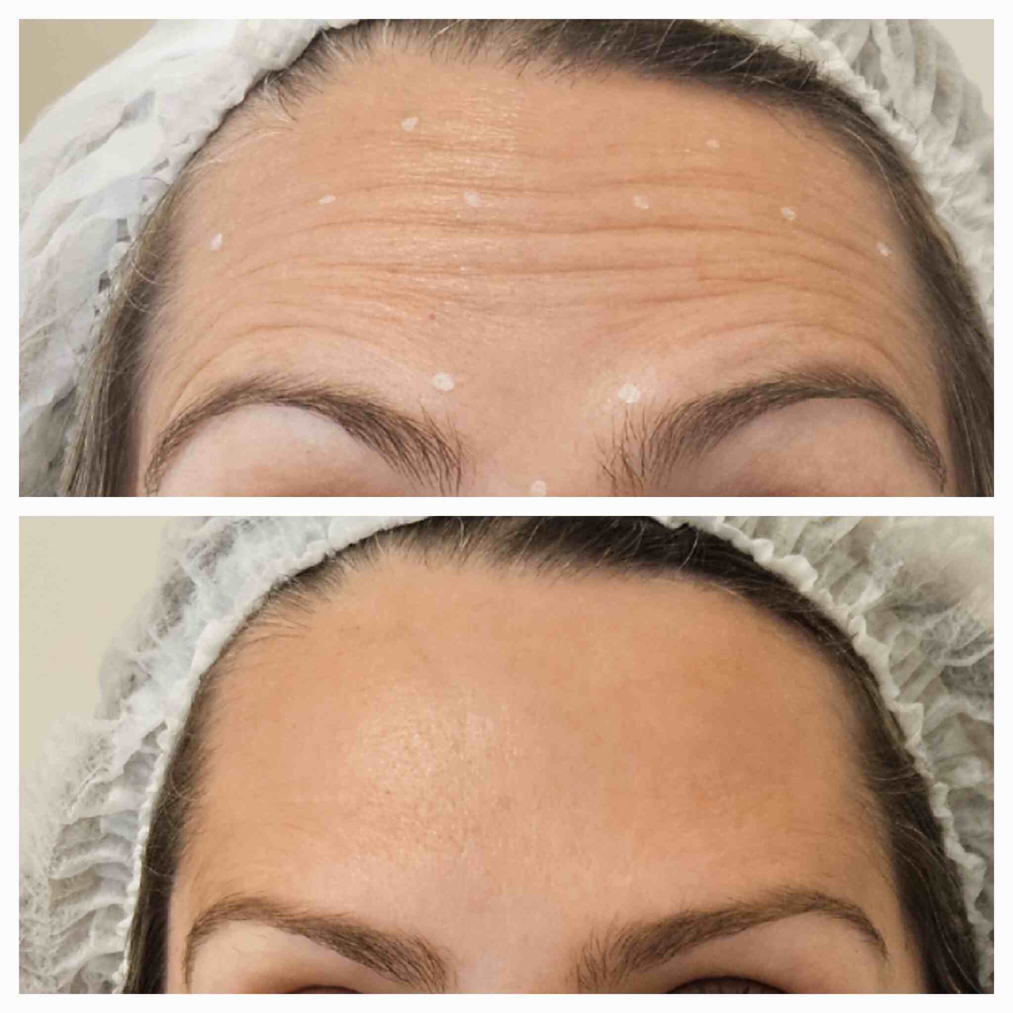 botox