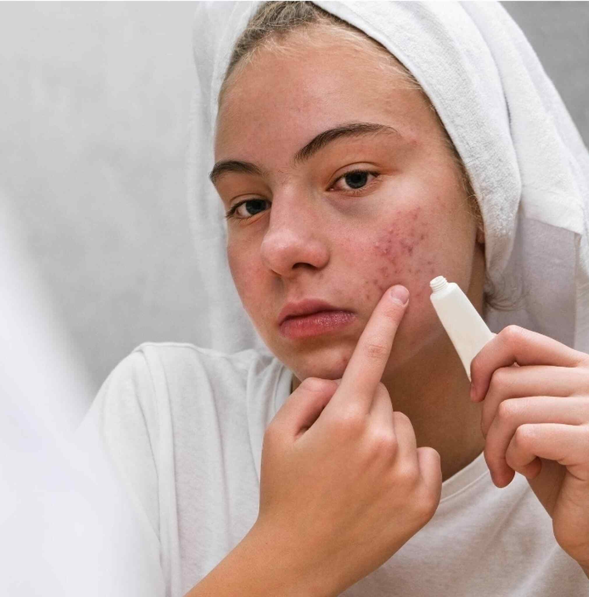 Tratamento tópico para acne