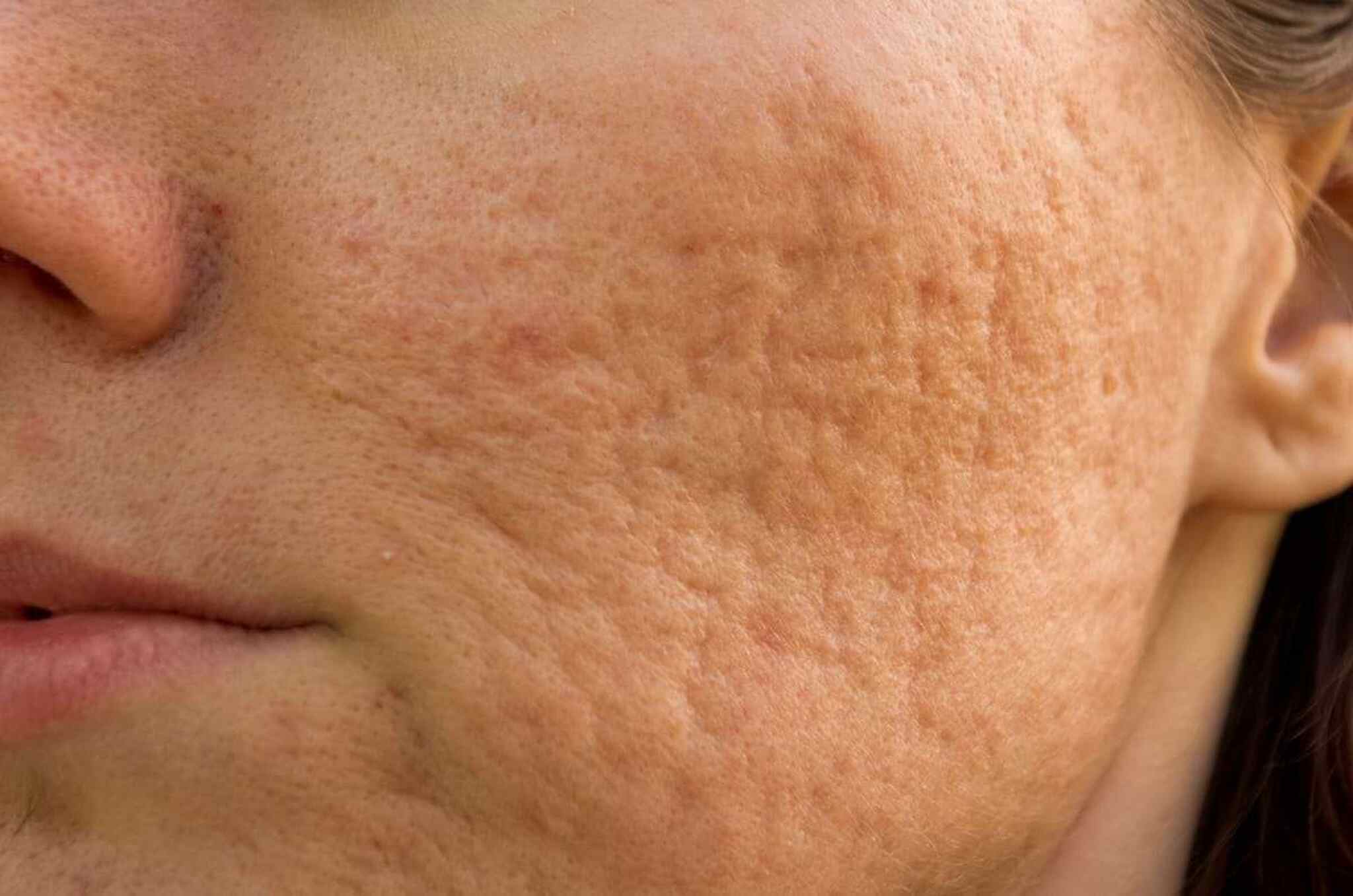 acne e cicatriz de acne