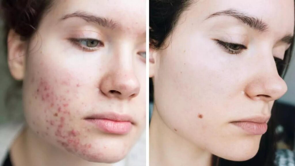 Isotretinoína oral é um medicamento excelente no tratamento da acne.