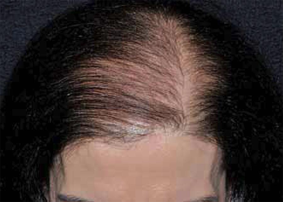A calvície feminina pode estar relacionada aos excesso de hormônios androgênicos e cursar junto com a acne e demais alterações hormonais