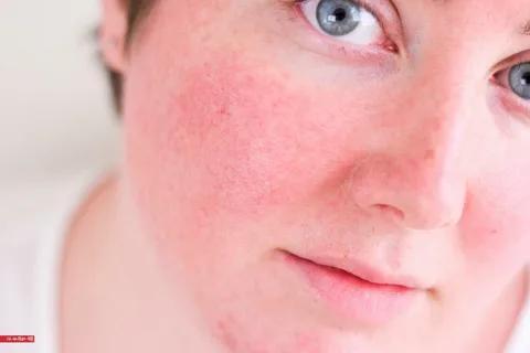 Eritema facial persistente.