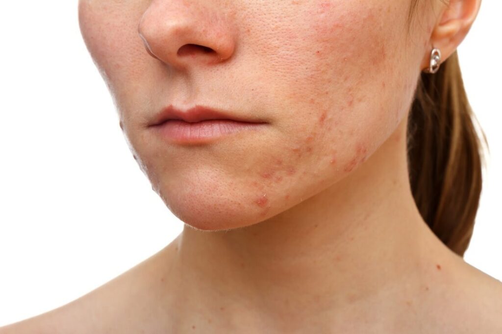A acne da mulher adulta se apresenta mais na região do queixo, mandíbula e pescoço.