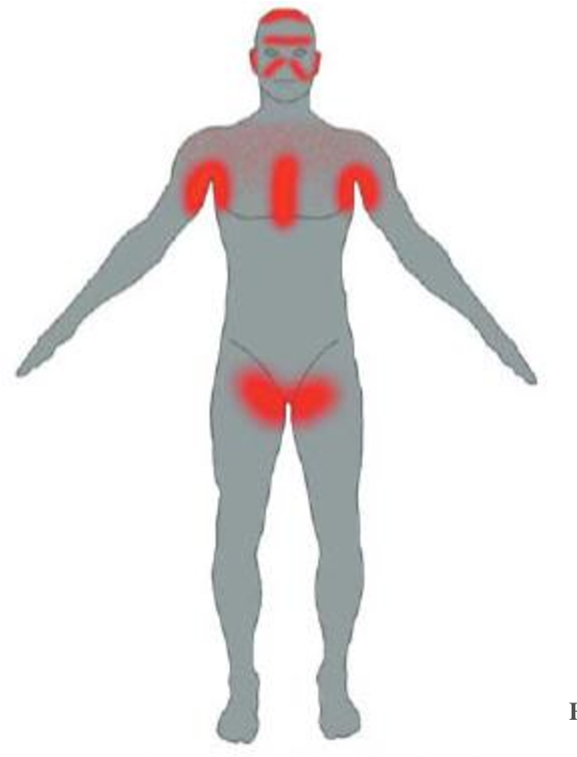 Imagem de um corpo humano mostrando os locais onde a dermatite seborreica pode se manifestar.