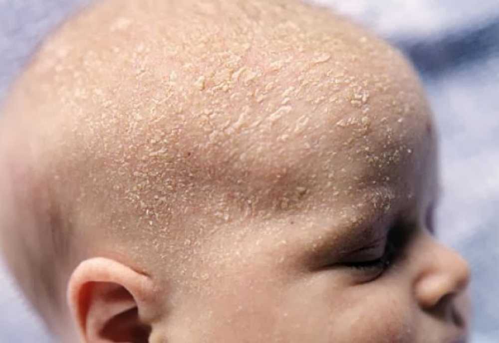 bebê com dermatite seborreica extensa na cabeça