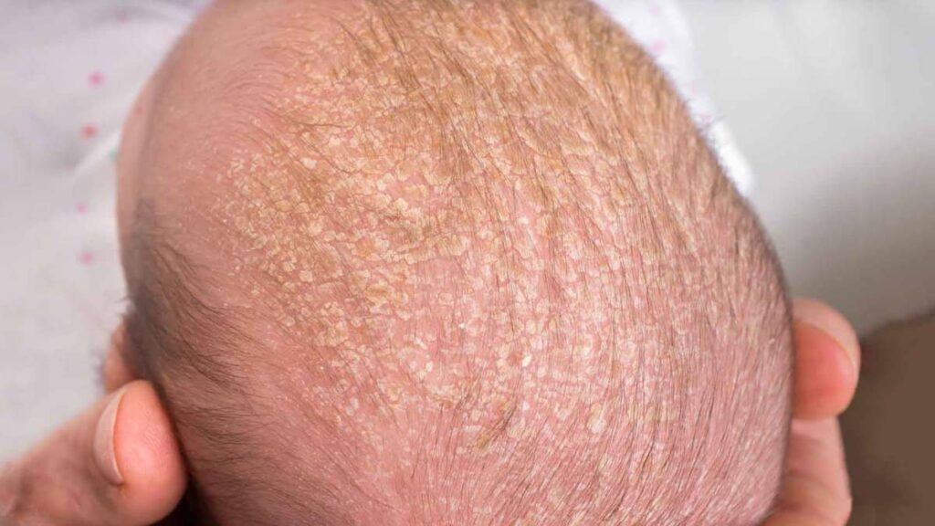 Dermatite seborreica na cabeça de uma bebê.