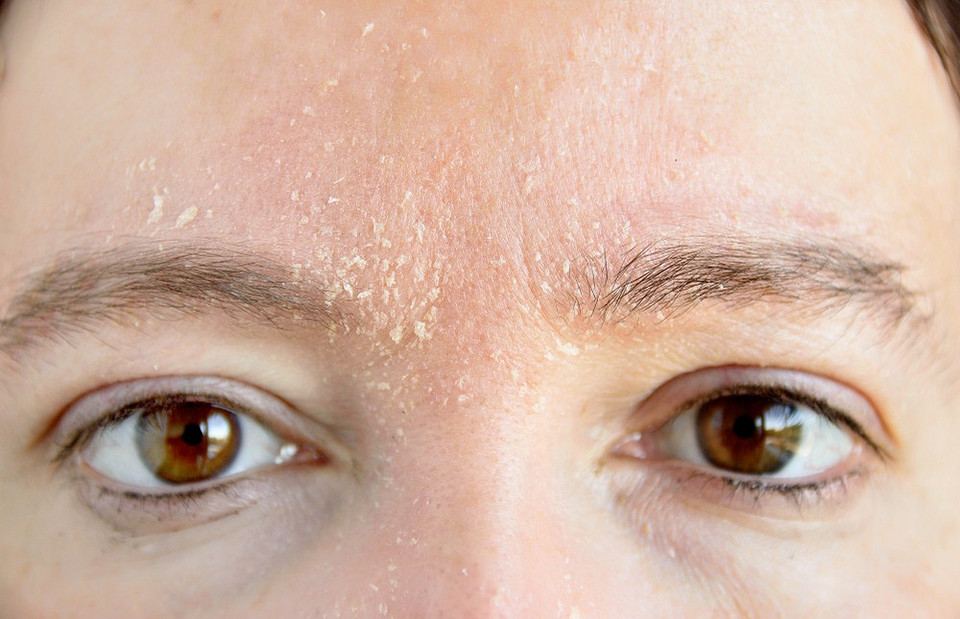 Homem com dermatite seborreica na glabela e nas sobrancelhas
