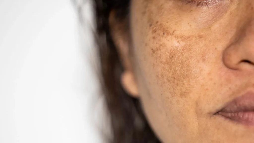 Apesar do melasma não ter cura, ele pode ser minimizado com eletroporação.