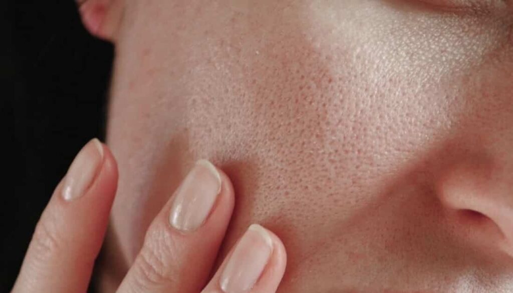 Minimizar o efeito dos poros abertos é uma possiblidade com eletroporação.