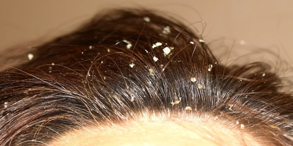 Dermatite seborreica com grandes crostas na cabeça de uma mulher