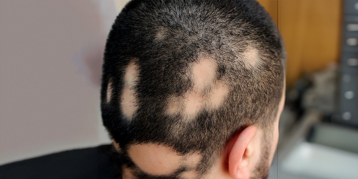Alopecia Areata em Placas é a forma de apresentação mais comum.