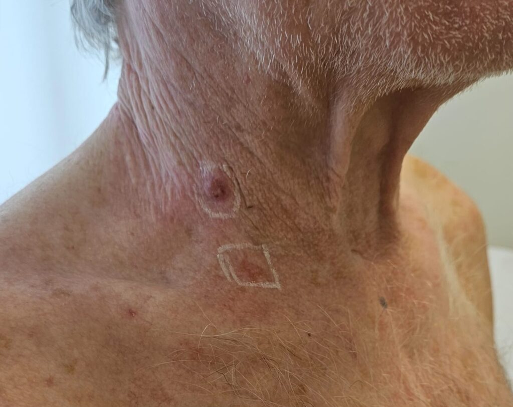 O pescoço sem proteção durante a vida pode levar a câncer de pele. Na foto, evidenciamos dois tipos de câncer de pele diferentes bem próximos um do outro, numa área do pescoço que nunca foi protegida durante a vida.-- foto de pesssõa com cancer de pele