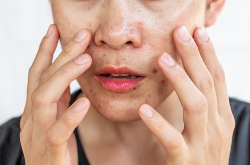 Aumento de oleosidade na pele do rosto é um sintoma muito comum na acne hormonal.