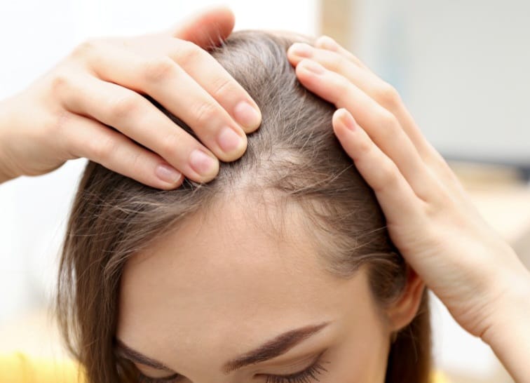 Mulheres também evoluem com perda de cabelos no topo da cabeça nos quadros de calvície feminina.