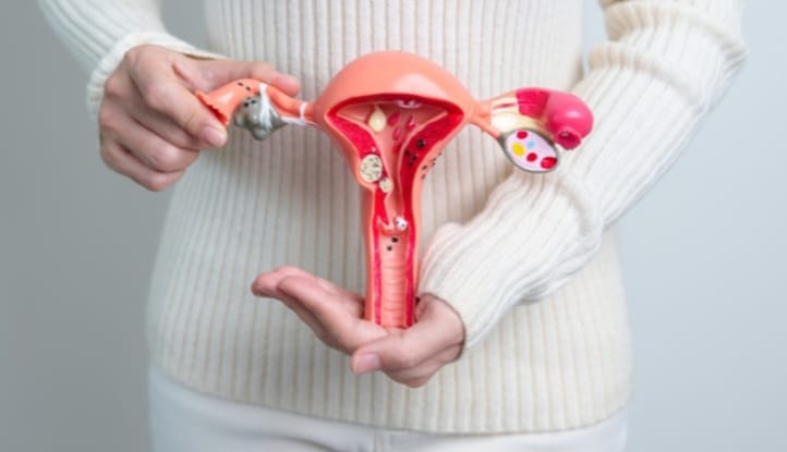 A síndrome dos ovários policísticos não precisa ter todos os sinais e sintomas para ser diagnosticada, mas nem toda mulher com acne hormonal tem a síndrome.