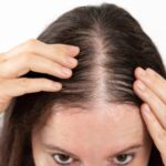 Queda concentrada no topo da cabeça é um dos primeiros sinais de alopecia androgenética (calvície)