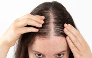 Queda concentrada no topo da cabeça é um dos primeiros sinais de alopecia androgenética (calvície)