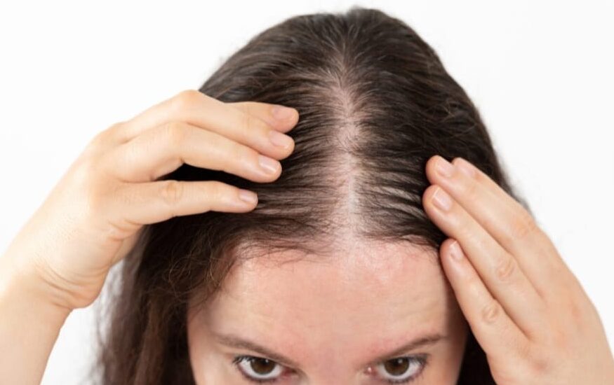 Queda concentrada no topo da cabeça é um dos primeiros sinais de alopecia androgenética (calvície)