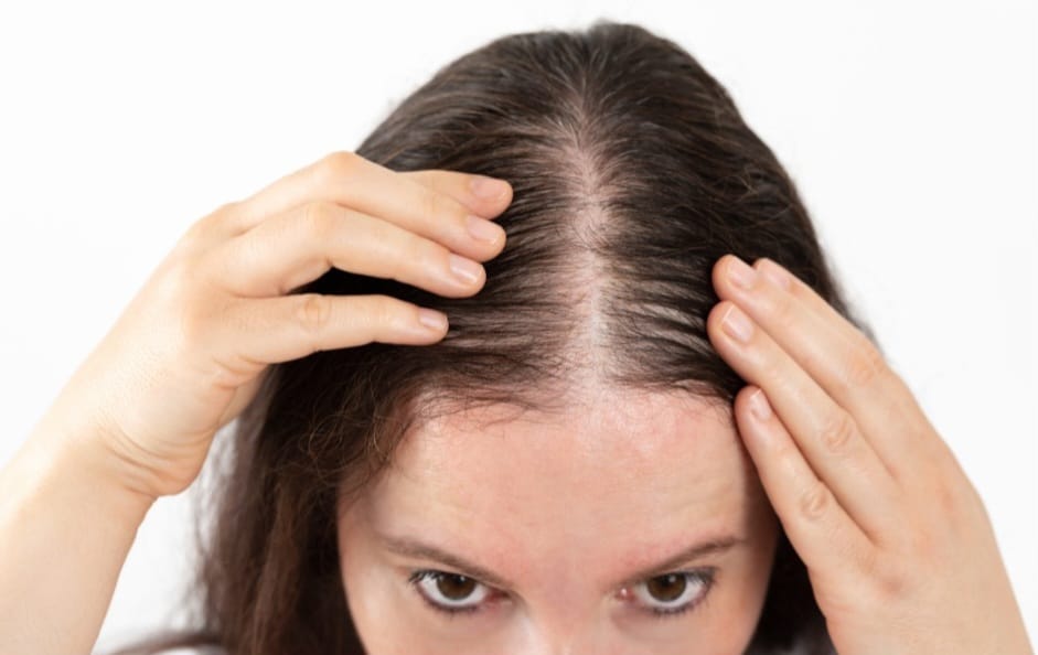 Queda de cabelo concentrada no topo da cabeça é um dos primeiros sinais de alopecia androgenética (calvície)