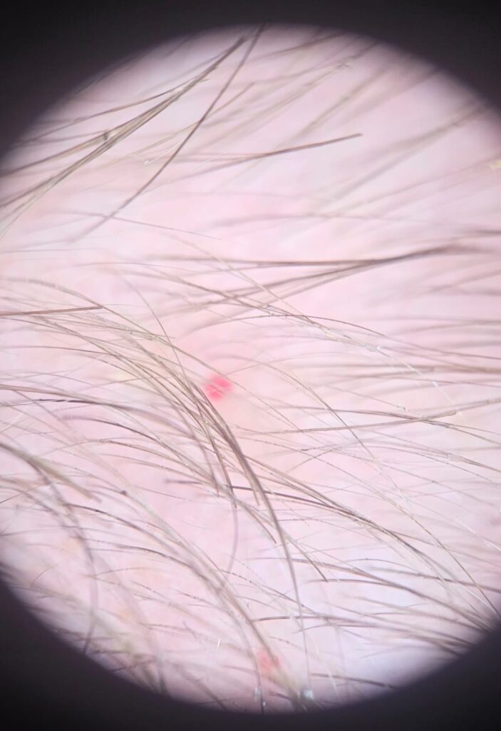 Dermatoscopia (ou tricoscopia) é o exame que nos permite analisar o afinamento dos fios na calvície.
fios afinados indicando queda hormonal
mulher mostrando rarefação capilar no topo da cabeça