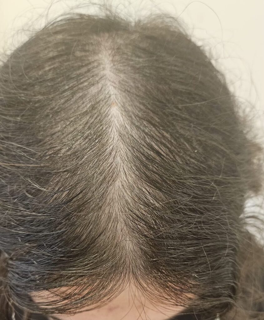 Oleosidade do couro cabeludo associada à rarefação dos cabelos do topo da cabeça.
couro cabeludo com oleosidade e queda de cabelo