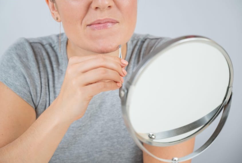 Quando há hirsutismo + afinamento capilar, há grande suspeita de queda hormonal.
Aumento de pelos, principalmente grossos no queixo, é um sinal de excesso de hormônios androgênicos.
mulher com pelos grossos no queixo indicando queda de cabelos hormonal.