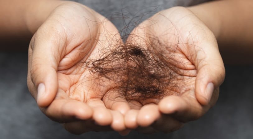 Depois do parto, os níveis caem rapidamente — e isso leva a uma queda bem intensa, conhecida como eflúvio telógeno pós‑parto.
Eflúvio telógeno pós‑parto apenas de ter relação com a queda hormonal pós-parto não é calvície. É reversível sem necessidade de medicação específica para calvície.
queda de cabelo pós parto