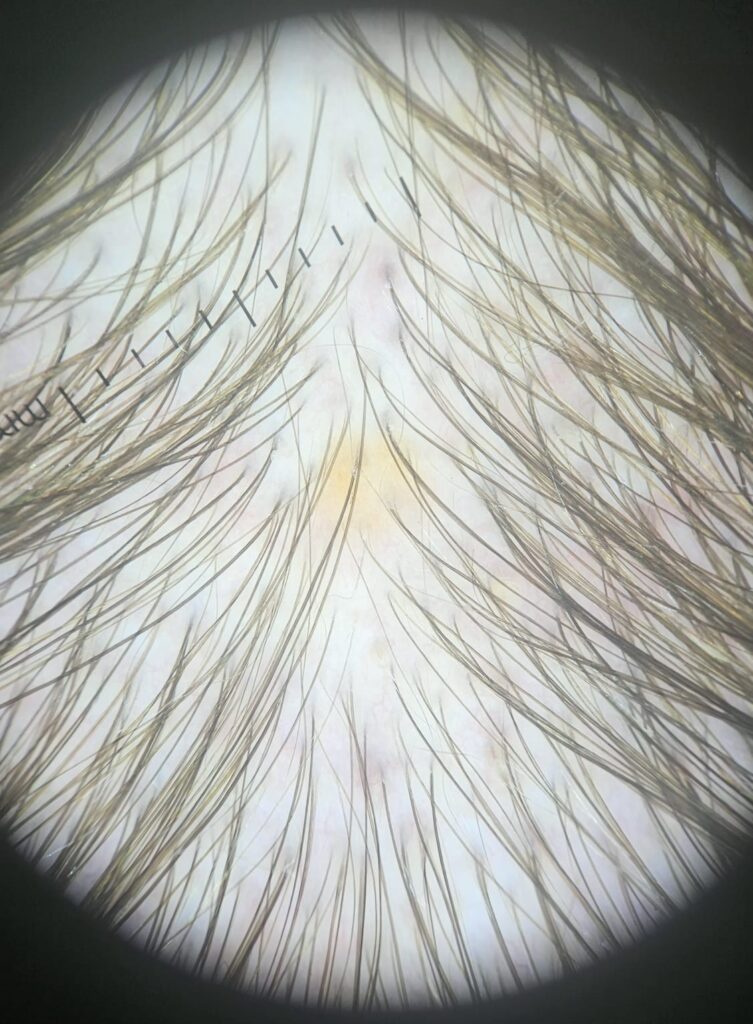 Tricoscopia de couro cabeludo mostrando afinamento e redução do número de fios no topo da cabeça.