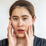 mulher com pele oleosa e acne