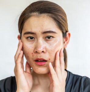 mulher com pele oleosa e acne