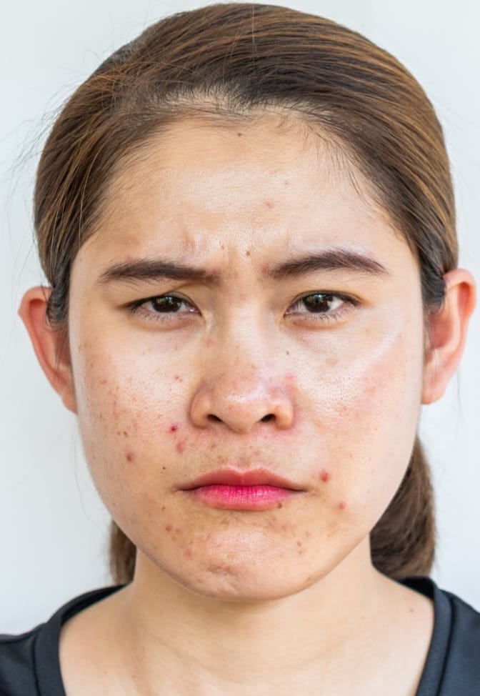 Mulher com pele oleosa e mulher com acne- acne hormonal